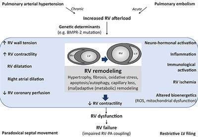 Inflammation in Right Ventricular Failure: Does It Matter?